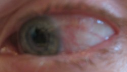 pre-op-2008-11-23-as 11/23/08 Eyeball