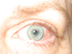 pre-op-2008-11-23-s 11/23/08 Pre-Op Eye